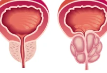 Prostate
