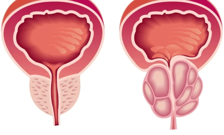 سرطان البروستات وأمراض الغدة: دليل شامل للأعراض والعلاجات 1 Prostate