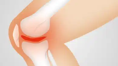 مجموعة من الأعشاب الطبيعية المستخدمة في علاج التهاب المفاصل الروماتيز مثل الكركم والزنجبيل