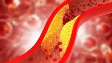 7 أعراض تدل على مرض الكوليسترول و ارتفاعه في الدم ومخاطره على صحة القلب