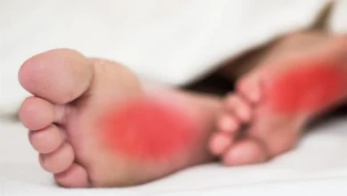 تنميل القدمين