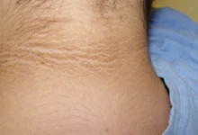 الشواك الأسود علامة جلدية صادمة تنذر بمرض خطير.. هل تظهر على رقبتك؟ 8 الشواك الأسود