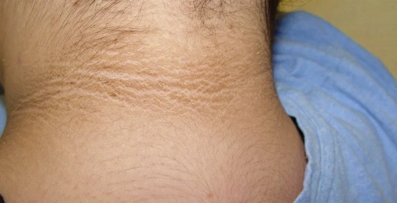 الشواك الأسود