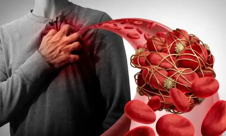 “لن تحتاج دواء القلب بعد الآن”… مشروب عشبي قديم يُذيب الجلطات ويُنظف الشرايين من الترسبات الخطيرة… حضره في بيتك. 1 جلطات