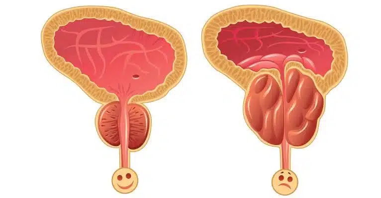 تضخم البروستاتا: هل حقاً تنتهي المعاناة في 7 أيام بنبتة منزلية؟ 1 875423876