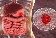 هل السونار يكشف سرطان القولون 1