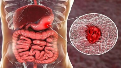 هل السونار يكشف سرطان القولون 1