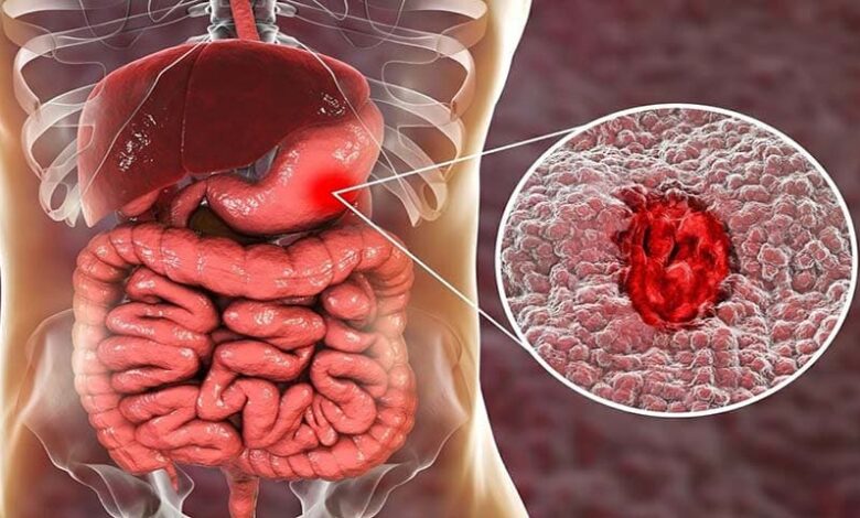 هل السونار يكشف سرطان القولون 1