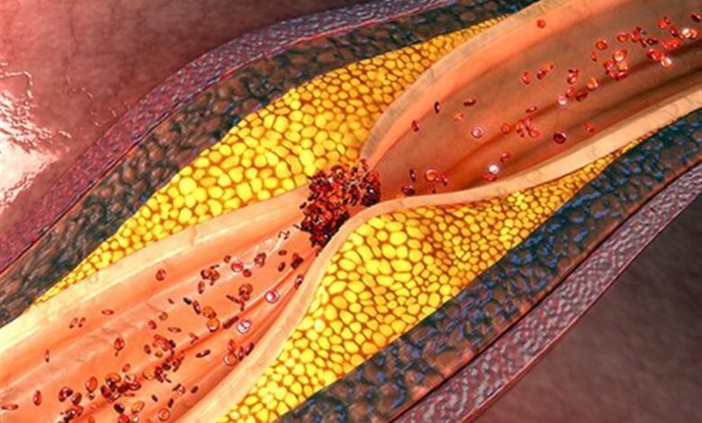 تصلب الشرايين وعلاجه: أحدث الدراسات عن تراجع اللويحات 2026 | دليل شامل 1 545645656575675756
