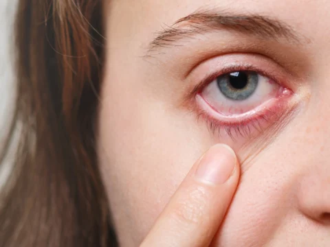هل تعاني من جفاف العين؟ هذه العادة اليومية قد تكلفك بصرك 1 dryEye