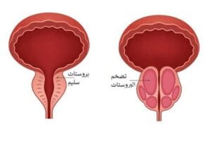 أعراض تضخم البروستاتا