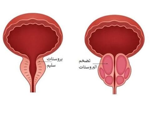 أفضل أعشاب تضخم البروستاتا: 5 وصفات لتحسين التبول وتخفيف الألم 1 أعراض تضخم البروستاتا