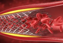 علاج انسداد الشرايين بدون جراحة