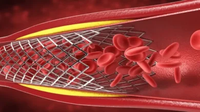 علاج انسداد الشرايين بدون جراحة