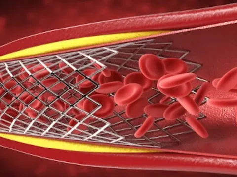 علاج انسداد الشرايين بدون جراحة.. 7 مكونات طبيعية من مطبخك تذيب الدهون وتنظف الأوعية الدموية 2 علاج انسداد الشرايين بدون جراحة