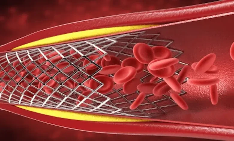 علاج انسداد الشرايين بدون جراحة