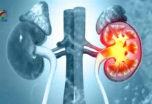 kidney stone
