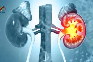 kidney stone