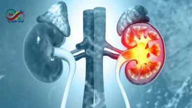 kidney stone
