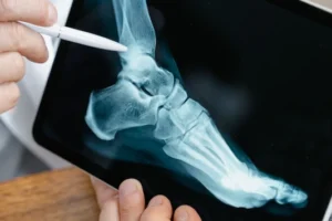 Osteoarthritis.